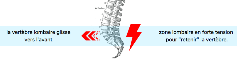 Comprendre le spondylolisthesis