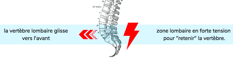 vertèbre lombaire déplacée