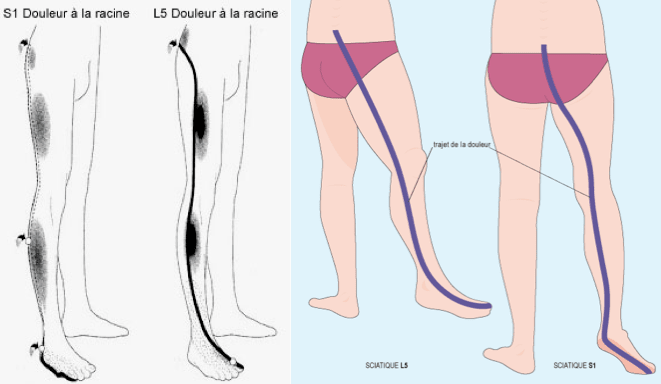 Sciatique L5 ou S1