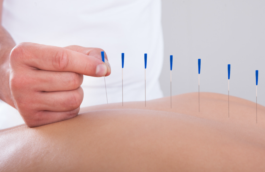 Acupuncture arrêt du tabac