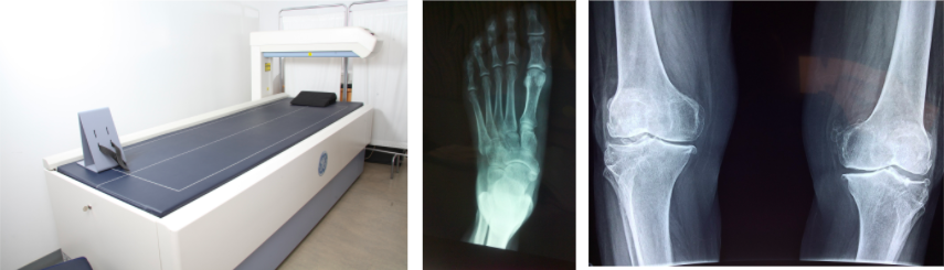 diagnostiquer fracture de fatigue