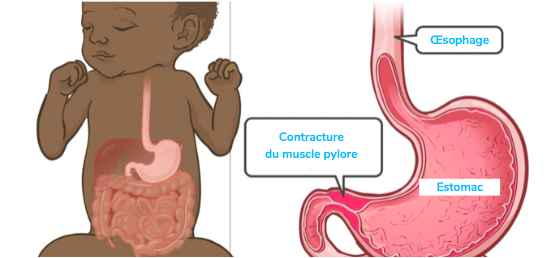 Stenose du pylore du bébé