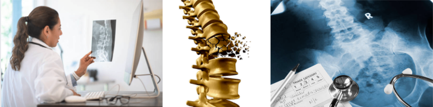 tassement vertébral diagnostic