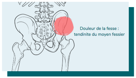 douleur sur le côté de la fesse et tendinite du moyen fessier