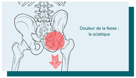 douleur dans la fesse et sciatique