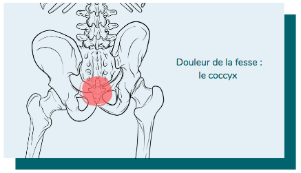 douleur au coccyx