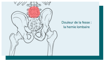 mal à la fesse et hernie discale