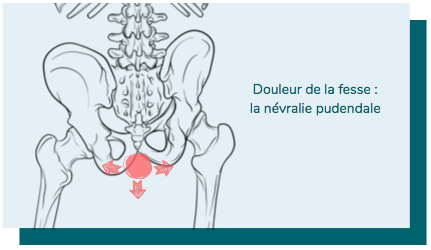 douleur à la fesse et névralgie pudendale