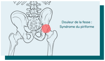 syndrome du piriforme et douleur à la fesse