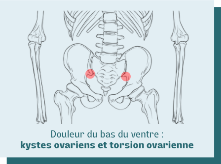 douleur ovaires