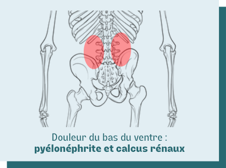 douleur colique calculs rénaux