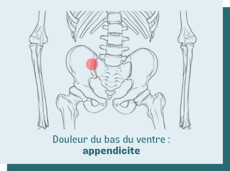 douleur appendicite