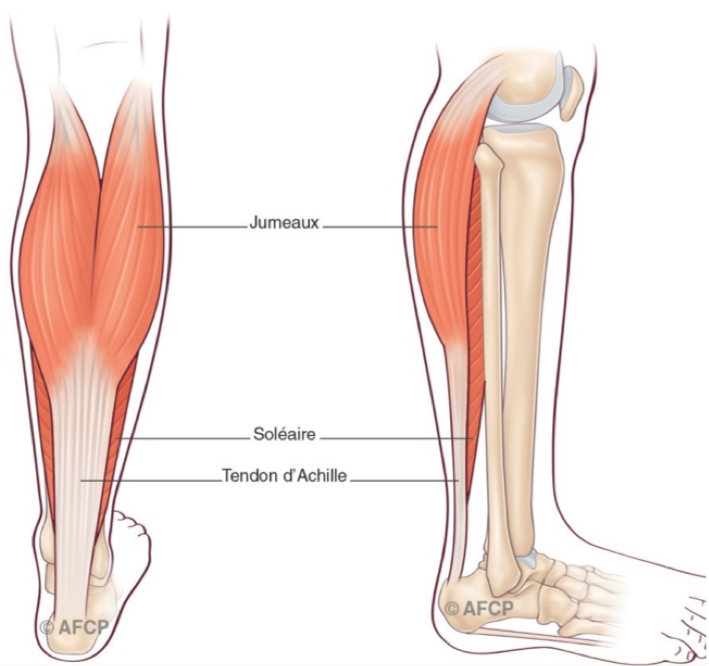 Tendinite d'Achille