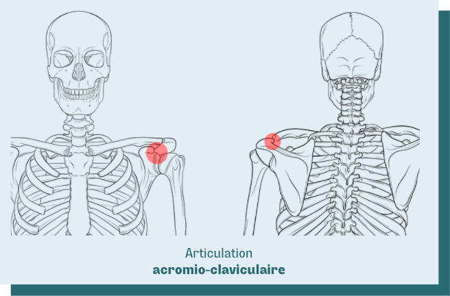 luxation acromio claviculaire