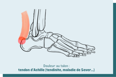 Douleur au talon : quelles causes et quels traitements ?