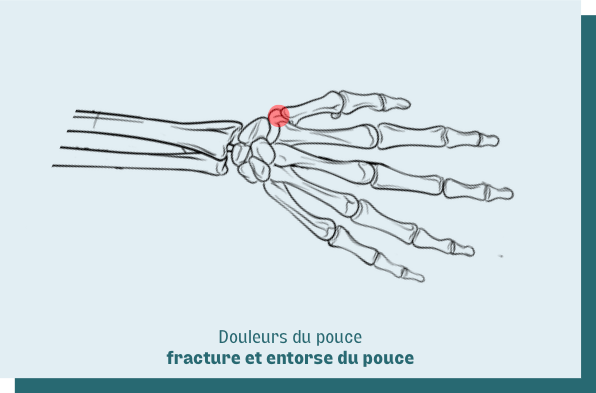 fracture et entorse du pouce