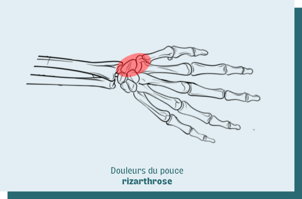 arthrose du pouce rizarthrose