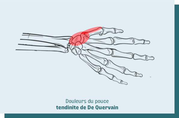 tendinite de de quervain