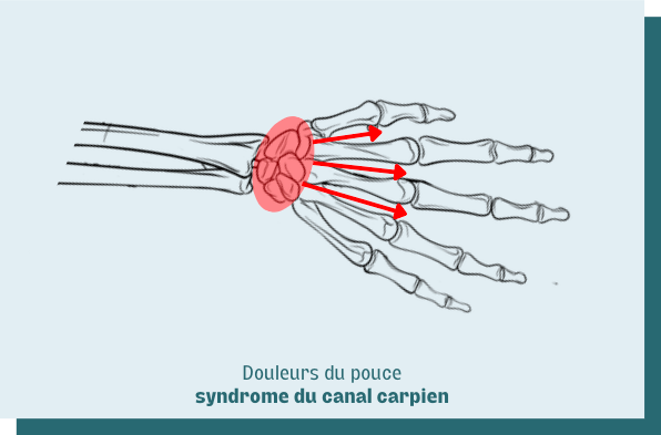syndrome du canal carpien