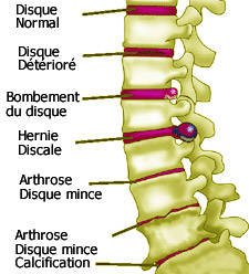 Traiter la hernie discale