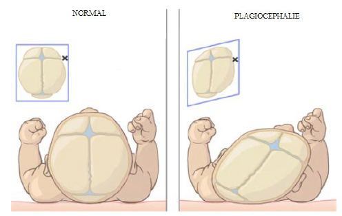 Tête plate, plagiocéphalie et ostéopathie