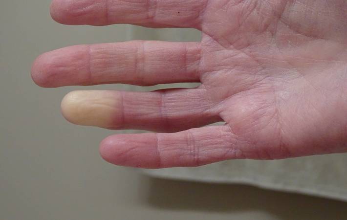 maladie de raynaud osteopathie