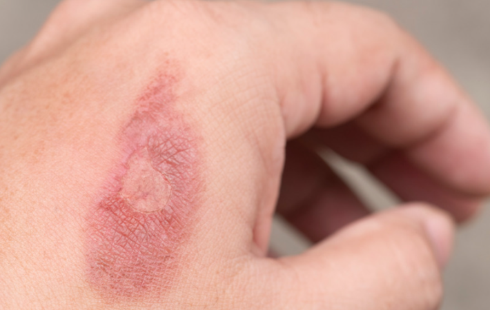 Cicatrices après une brûlure : quels traitements naturels ?